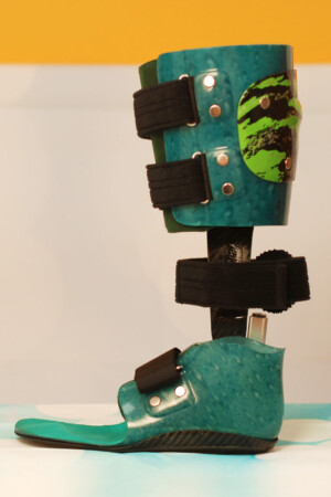 dynamische Fuß Unterschenkel -Carbon Prepreg Orthese mit thermoplastischem Innenschaft und Neuro Swing Gelenk, kombinierte Bauweise